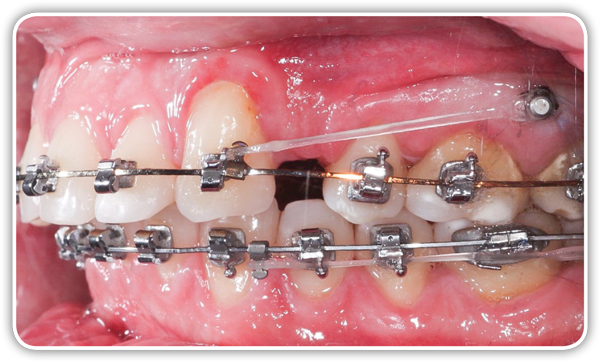 Orthodontic miniscrews, TAD